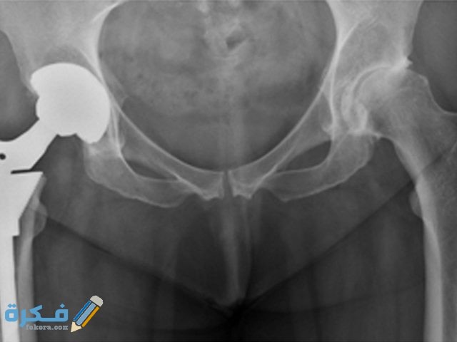 التخلص من ظاهرة التكلس