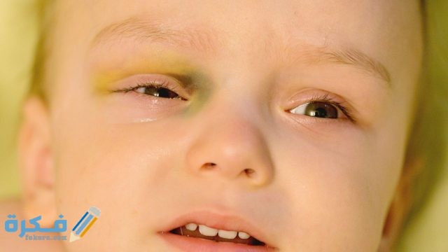 طريقة التخلص من كدمات الوجه