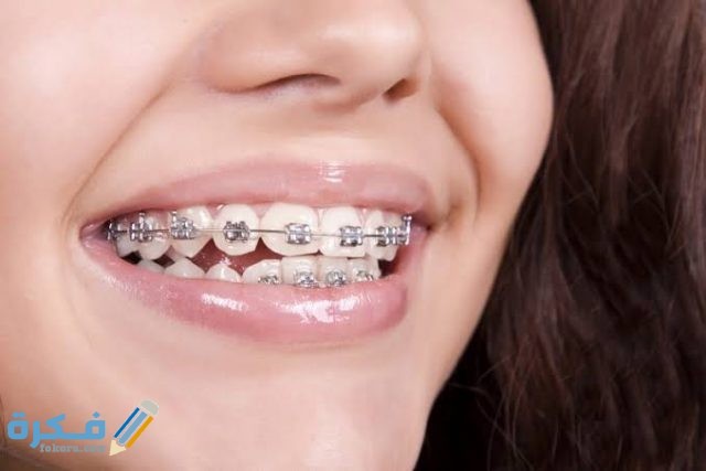 أسعار تقويم الأسنان بالجنيه في مصر