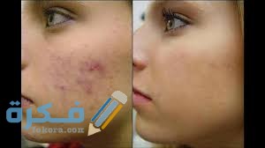 اسباب حب الشباب الملتهب وطرق علاجه اسباب حب الشباب الملتهب وطرق علاجه