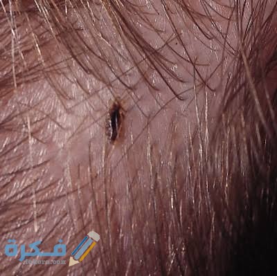 تفسير رؤية القمل تفسير رؤية القمل