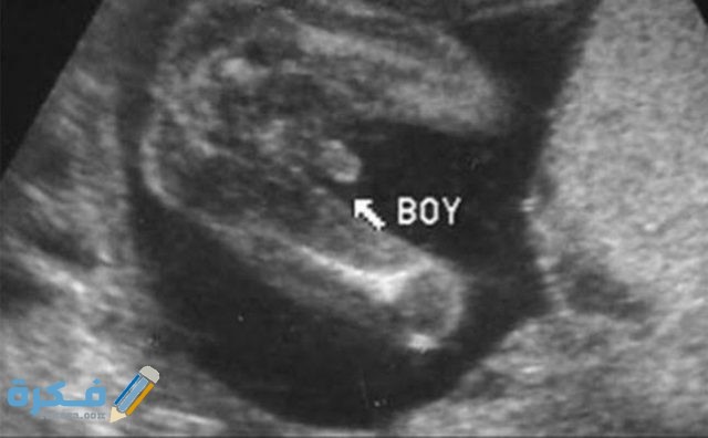 كم نسبة خطأ السونار في تحديد نوع الجنين