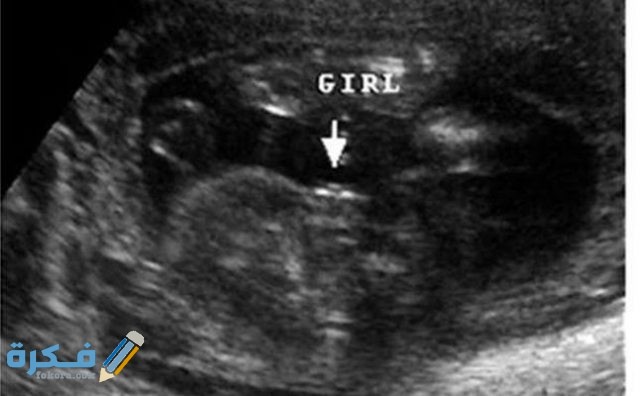 كم نسبة خطأ السونار في تحديد نوع الجنين