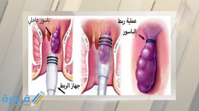 ما هي البواسير 