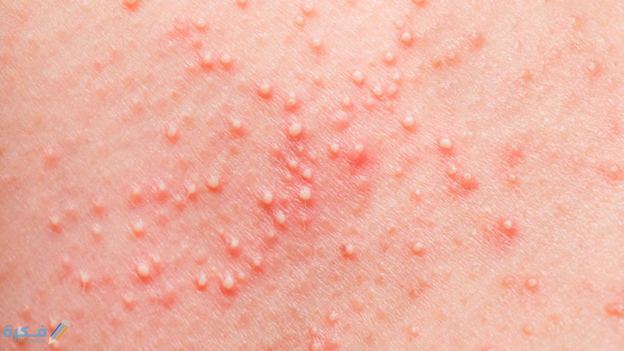 بعض أنواع الأدوية لعلاج حساسية الوجه