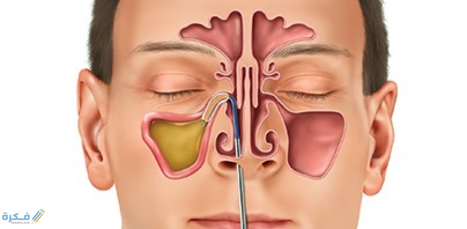 علاج حساسية الجيوب الأنفية