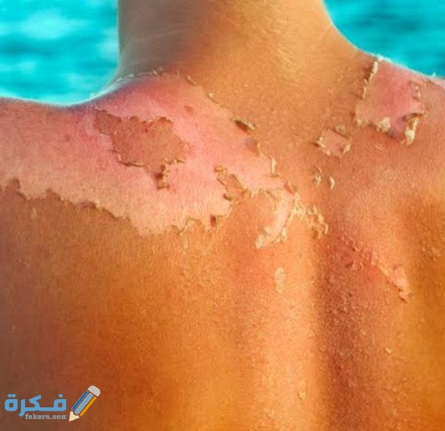 ماسك قشر الموز للوجه علاج حروق الشمس بعد السباحة وطرق الوقاية منها