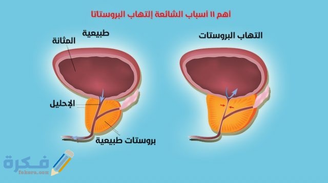 أسباب التهاب البروستاتا