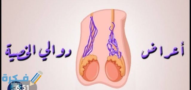 تكلفة عملية دوالي الخصية
