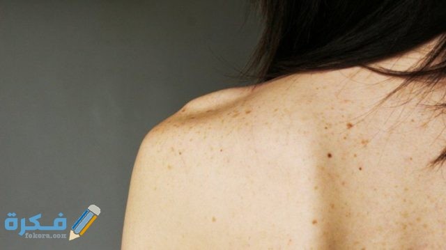 تفسير رؤية شامات على الجسم