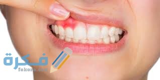 علاج خراج الأسنان المزمن في المنزل