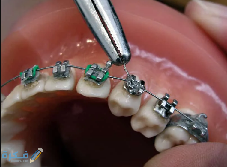 مصادر أجهزة تقويم الأسنان