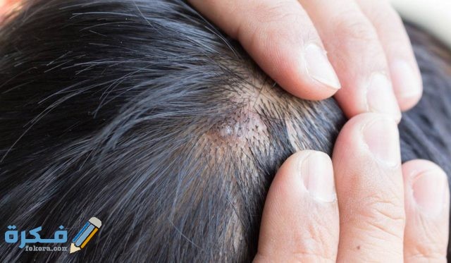 تفسير رؤية جرح في الرأس في المنام