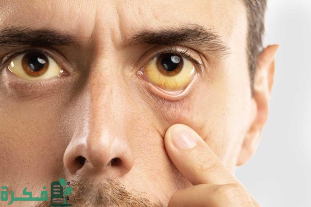 ما سبب اصفرار في العينين