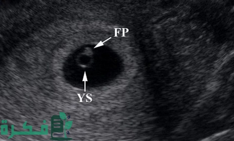 هل ظهور كيس في الرحم يعني حمل