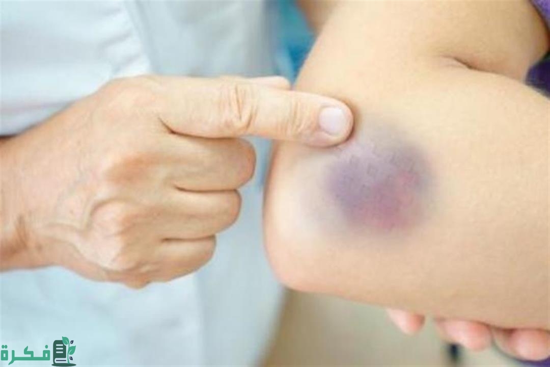 ما سبب ظهور بقع زرقاء في الجسم للحامل 12 2021 11 18 13 23 50 741