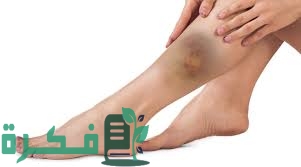 ماذا يعني ظهور بقع زرقاء في الساق للحامل 5 4782685D E5D0 46EC 9A58 AD77AAEA3D3F