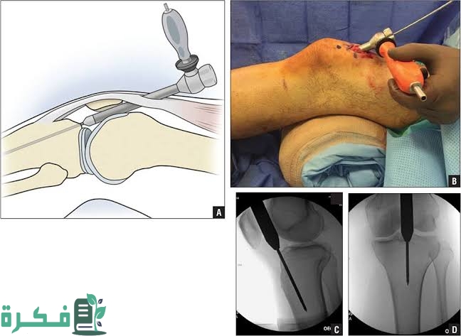 تجربتي مع المسمار النخاعي تجربتي مع المسمار النخاعي