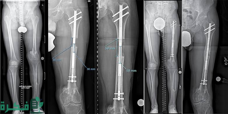 تجربتي مع المسمار النخاعي تجربتي مع المسمار النخاعي
