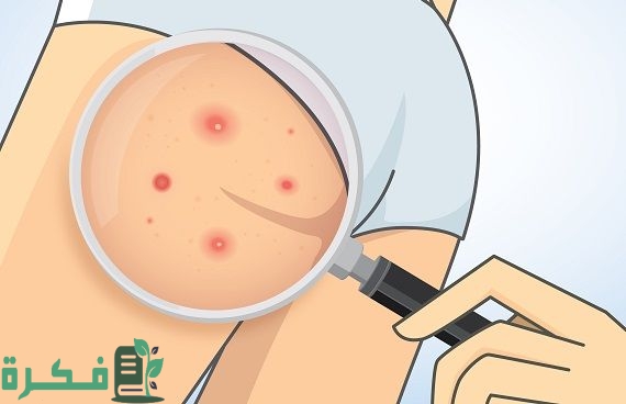 أسباب ظهور الحبوب في المؤخرة