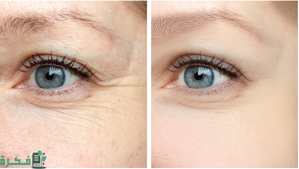 تجربتي في التخلص من تجاعيد العين