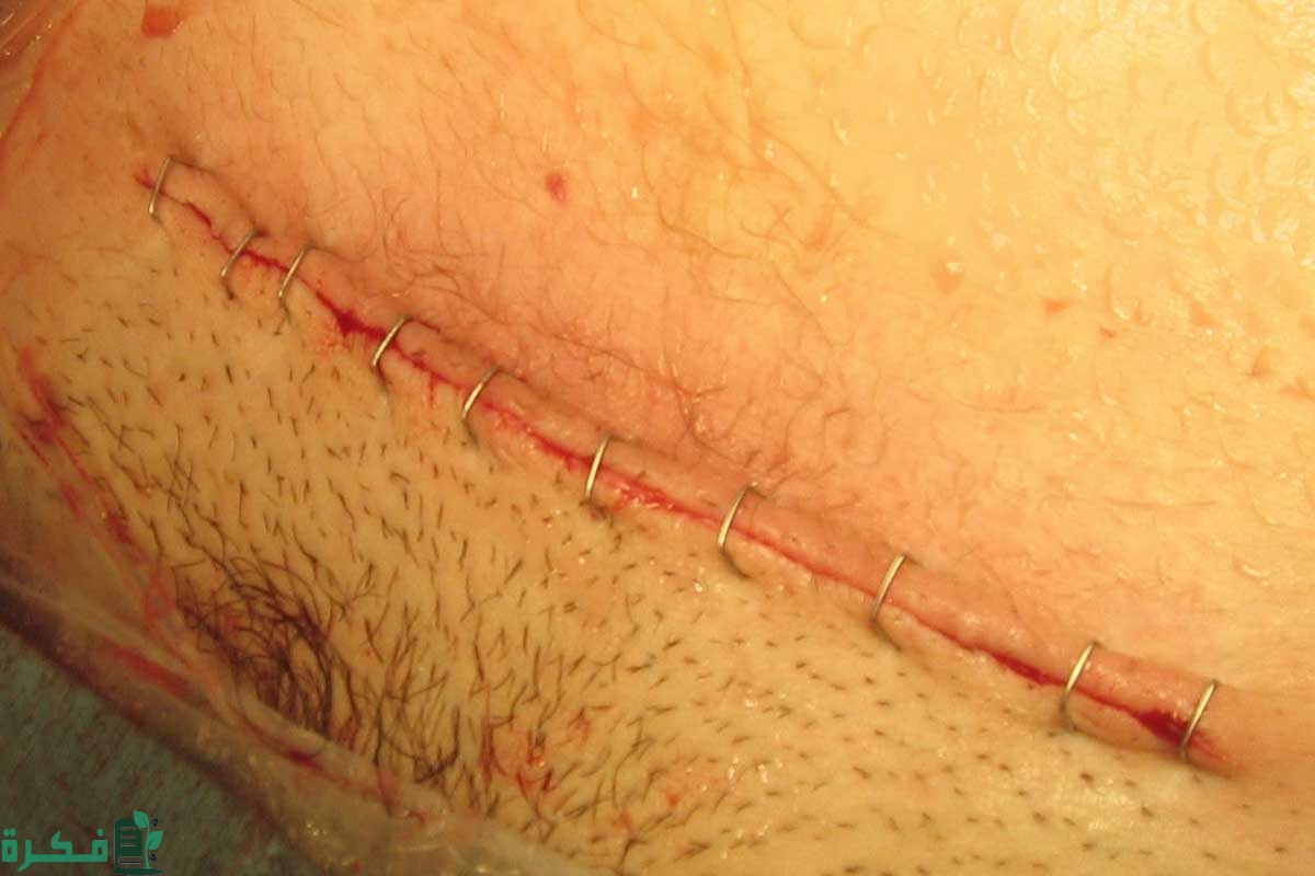 خياطة العملية القيصرية الكبس