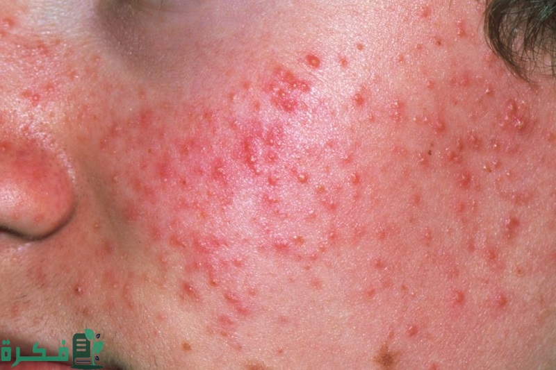 دواء حب الشباب من الصيدلية