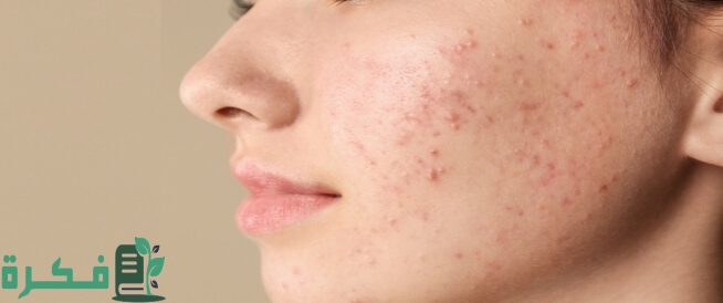 اسم دواء حب الشباب من الصيدلية 3 دواء حب الشباب من الصيدلية