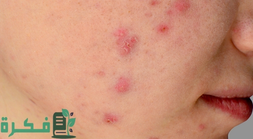دواء حب الشباب من الصيدلية