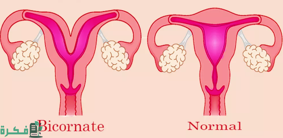 شكل الرحم ذو القرنين بالسونار