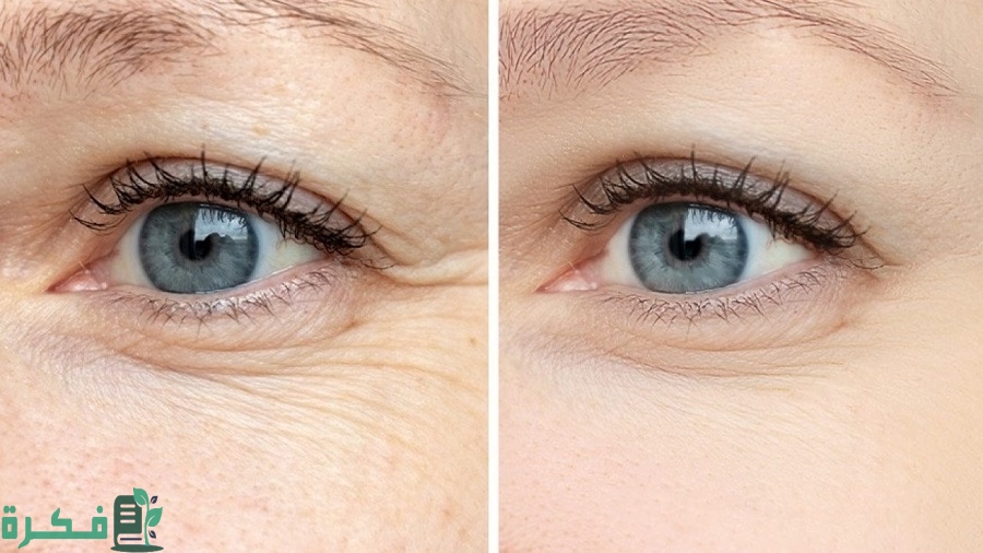 طرق إزالة التجاعيد تحت العين