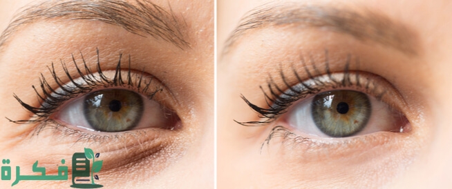 طرق إزالة التجاعيد تحت العين
