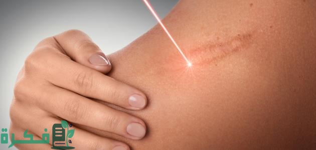 طريقة علاج آثار الحروق