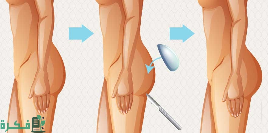 عملية نحت الخصر وتكبير المؤخرة