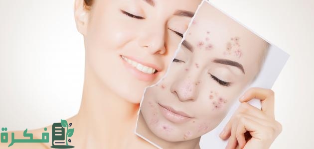 ماسكات للبشرة الدهنية وحب الشباب سريعة المفعول