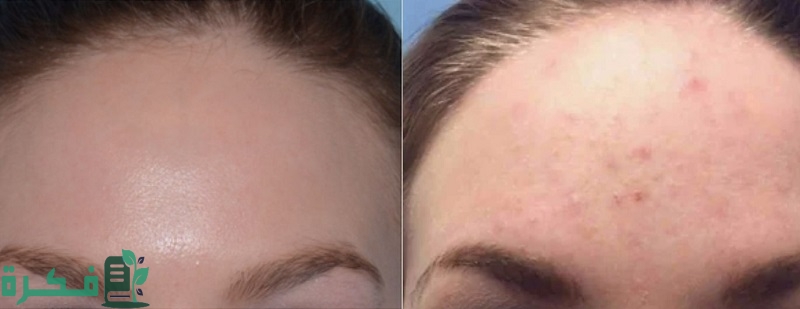 نتائج الديرما بن قبل وبعد