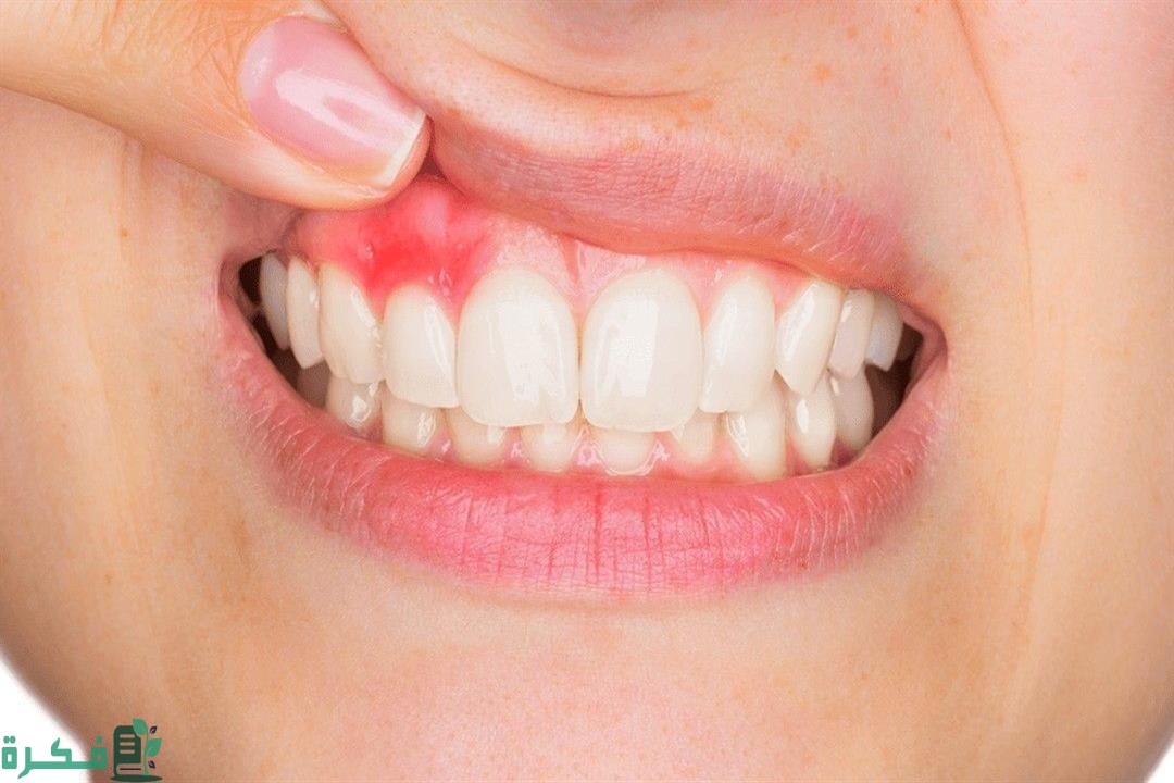 أسماء افضل 5 أدوية علاج التهاب اللثة والأسنان في المنزل 3 أفضل 5 أدوية علاج التهاب اللثة والأسنان في المنزل