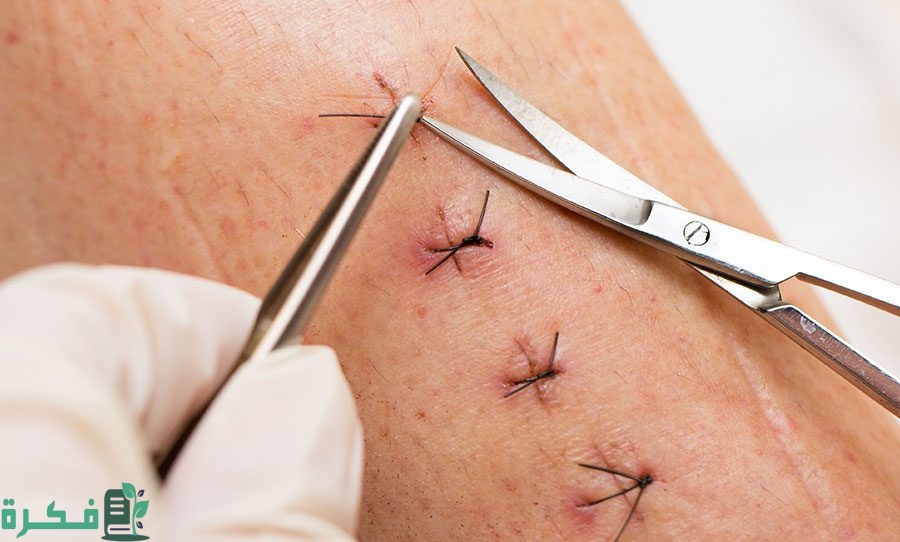 أفضل 5 أكلات تساعد على التئام جروح العمليات