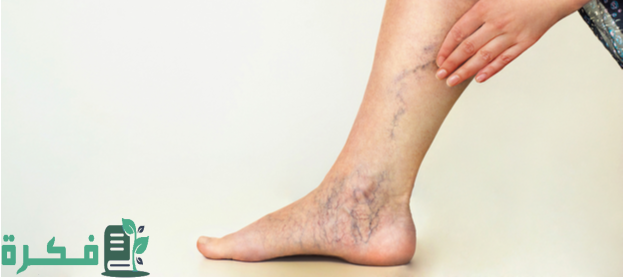 أسماء افضل 5 أنواع كريم لعلاج دوالي الساقين 57 أفضل 5 أنواع كريم لعلاج دوالي الساقين في مصر