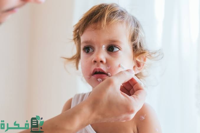 أفضل 5 أنواع مرهم لعلاج الجدري المائي