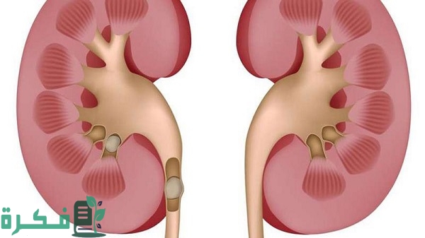أفضل 5 مشروبات لتفتيت حصوات الحالب