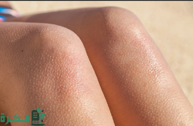 أفضل الكريمات الطبية والمرطبات لعلاج مشكلة جلد الدجاجة