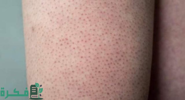 أفضل الكريمات الطبية والمرطبات لعلاج مشكلة جلد الدجاجة