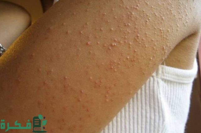 أكثر الطرق فاعلية للتخلص من جلد الإوزة