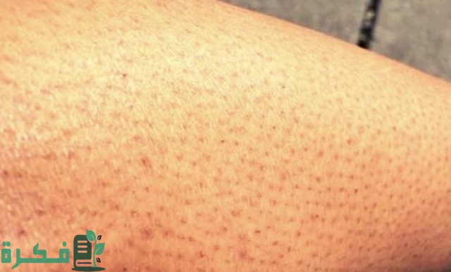 أكثر الطرق فاعلية للتخلص من جلد الإوزة