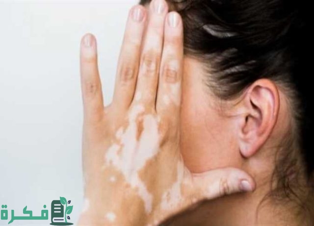 الأطعمة التي يجب تناولها للتخلص من البهاق