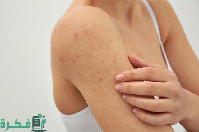 طرق إزالة الحبوب من الذراعين طرق إزالة الحبوب من الذراعين