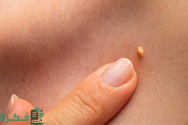 طرق سهلة لعلاج الثالول بالمنزل