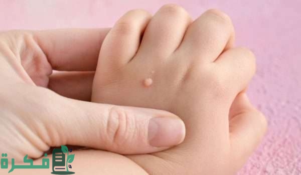 طرق سهلة لعلاج الثالول بالمنزل