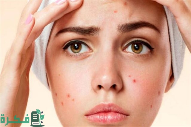طرق منزلية للتخلص من حب الشباب الهرموني طرق منزلية للتخلص من حب الشباب الهرموني